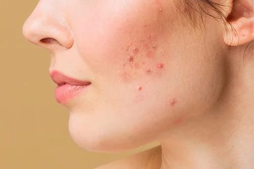 Acné en adultos: Por qué aparece y los tratamientos que realmente funcionan Acné